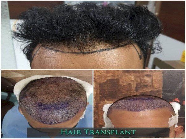 Is Hair Transplant in Pakistan Worth It?