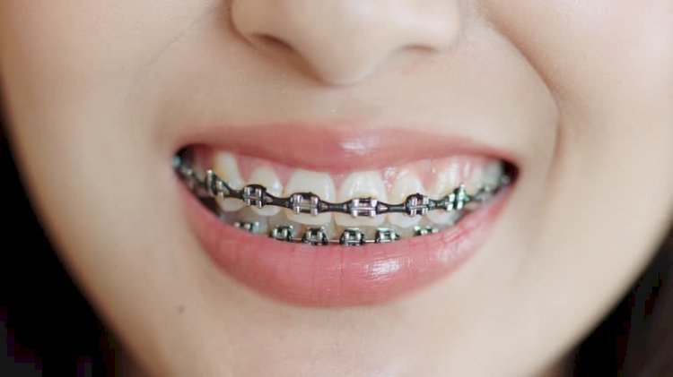 Can anyone suggest a good dentist in Karachi And how much braces cost? 