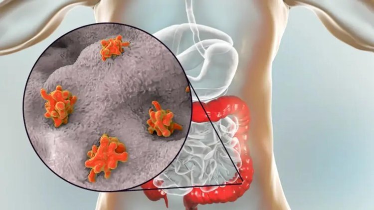 Understanding the Role of Nizonide in Amebiasis Care