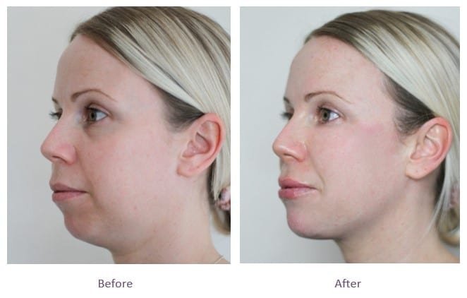 The Aesthetic Journey: From Consultation to Results for Jawline Fillers in Dubai