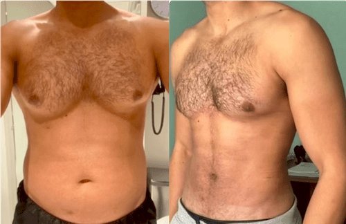 Advanced Techniques for Gynecomastia Surgery in Dubai