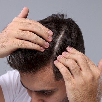 FAQs About Hair Transplants in Islamabad: Get Your Answers Here