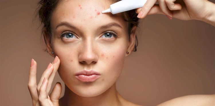 Transform Your Skin with Proven Acne Solutions