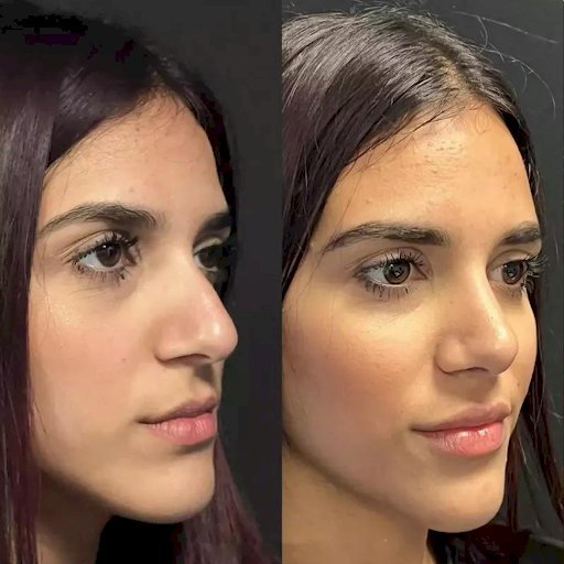 Navigating Rhinoplasty in Dubai: A Step-by-Step Process