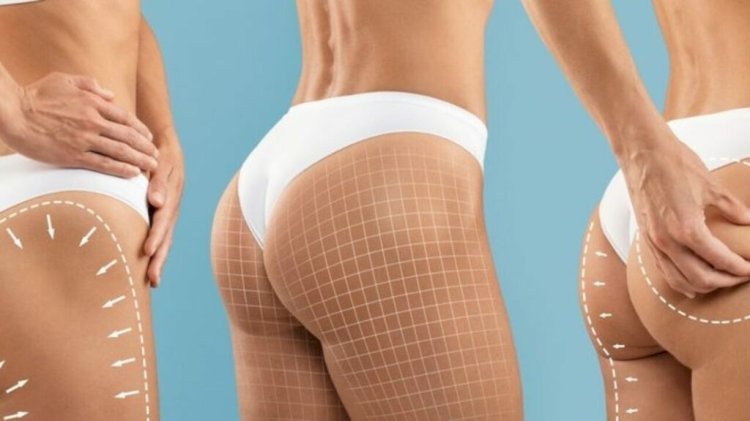 Achieving a Natural Look with Butt Fat Transfer in Dubai