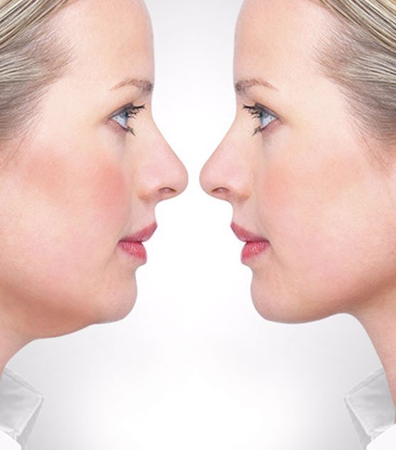 "The Role of Dermal Fillers in Double Chin Treatment"