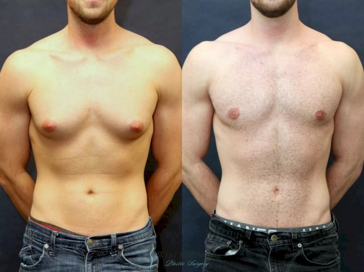 Gynecomastia Surgery in Dubai: How to Prepare for the Procedure