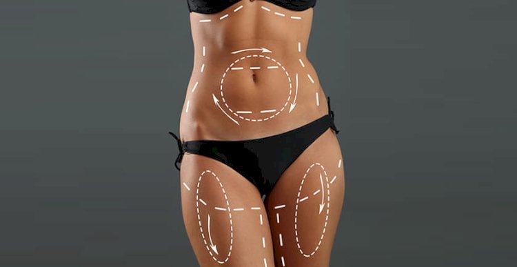 Is Liposuction Right for You? Understanding the Procedure and Results