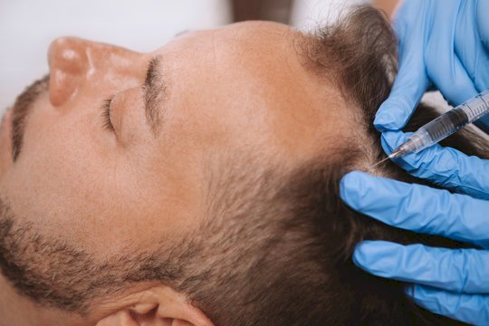 Hair Fall Treatment for Men: Causes, Solutions & Effective Treatments