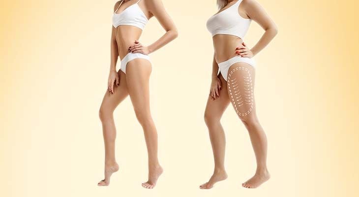 Liposuction in Dubai – Achieve Your Dream Body with Expert Care