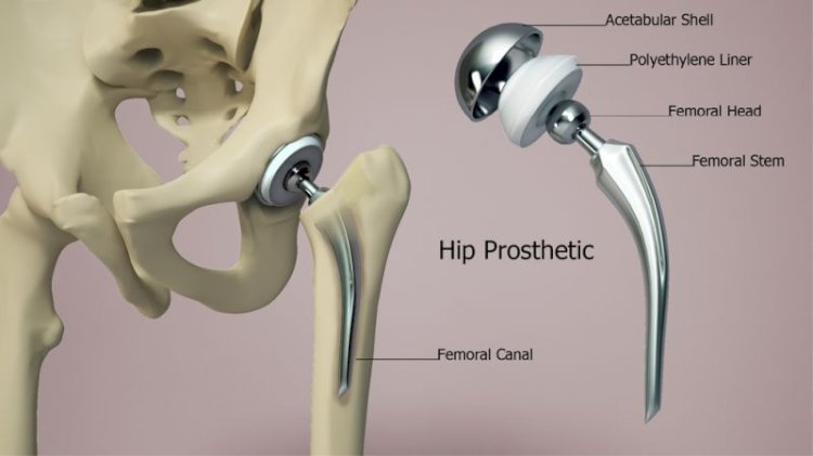 Hip Replacement in Islamabad for Seniors: A Safe Path to Relief