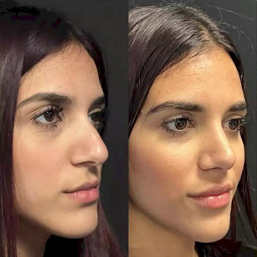 From Consultation to Recovery: Best Rhinoplasty Surgeon in Dubai Guide