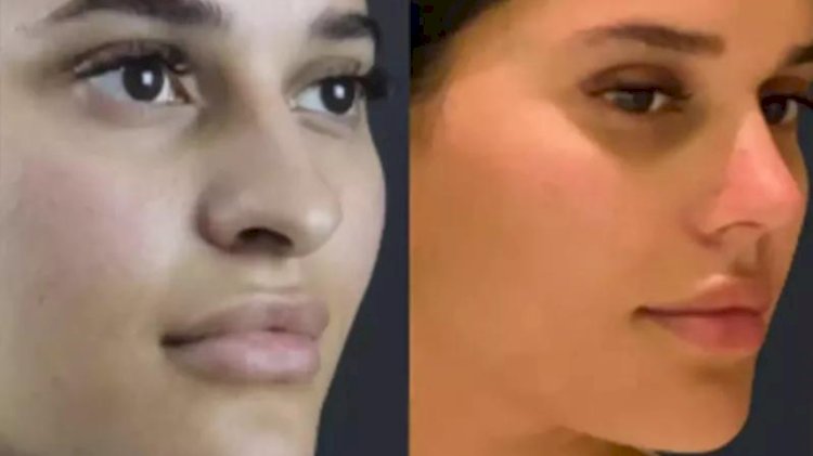 How to Find the Best Septoplasty Surgeon in Dubai