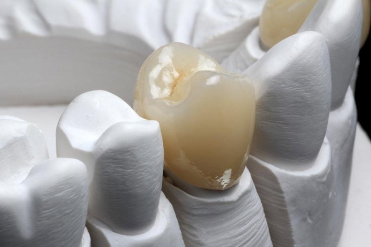 Tips For Selecting The Best Dental Crown For Your Requirements