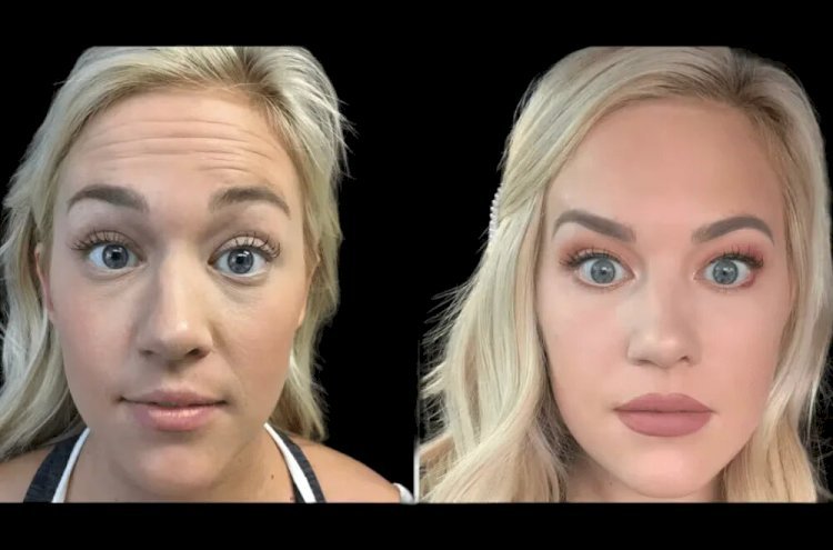 Anti-Aging in the Desert: Why the Best Doctors in dubai Recommend Botox