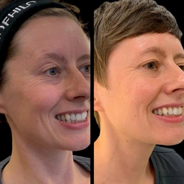 How the Best Doctors in Dubai Are Combining Profhilo with Other Treatments for Maximum Results