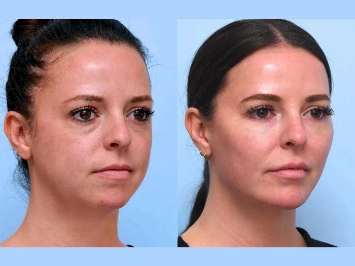 How to Find the Best Doctors in Dubai for a Non-Surgical Thread Lift