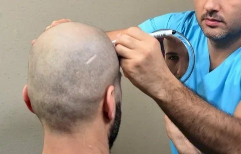 Hair Transplant in Dubai 2025: Your Comprehensive Guide to Modern Hair Restoration
