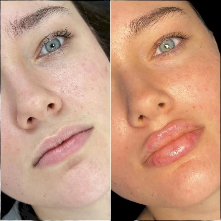 Sculpt Your Face with Fillers Treatment in Dubai