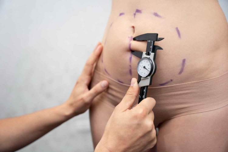 How much does liposuction cost in Delhi?