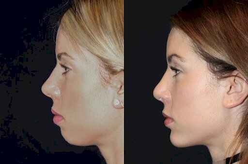Chin Fillers in Dubai Can Boost Your Confidence and Appearance