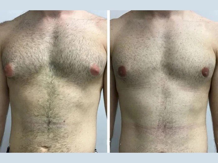 Why Men Are Opting for Gynecomastia Surgery in Dubai