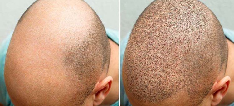 DHI Hair Restoration Albania: De Slimme Keuze voor Britten met Haarverlies
