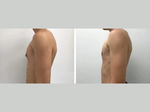 The Best Gynecomastia Surgeons in Dubai for Natural-Looking Results