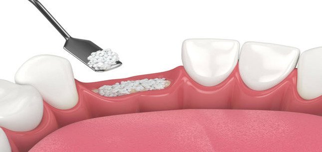 What Is Dental Bone Grafting? A Simple Explanation for Patients