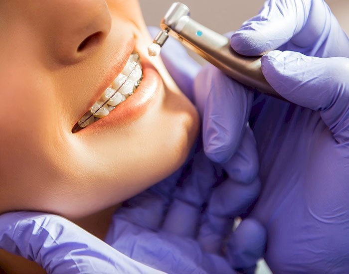 Discover Your Best Smile with Braces or Invisalign at Orb Dental in Brampton
