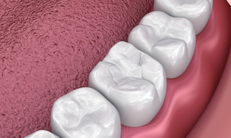 What’s the Best Filling Material for Front Teeth