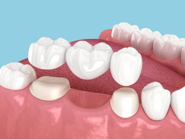 When Should You Replace an Old Dental Bridge