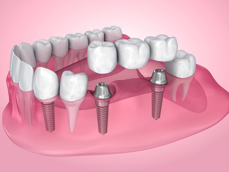 Reclaim Your Confident Smile with Dental Bridges in York: What You Need to Know