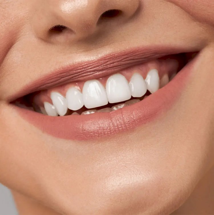 How Teeth Whitening Cost Matches Expectations