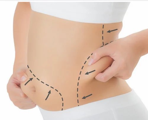 Tummy Tuck and Diastasis Recti: Real Repair for Core Muscles