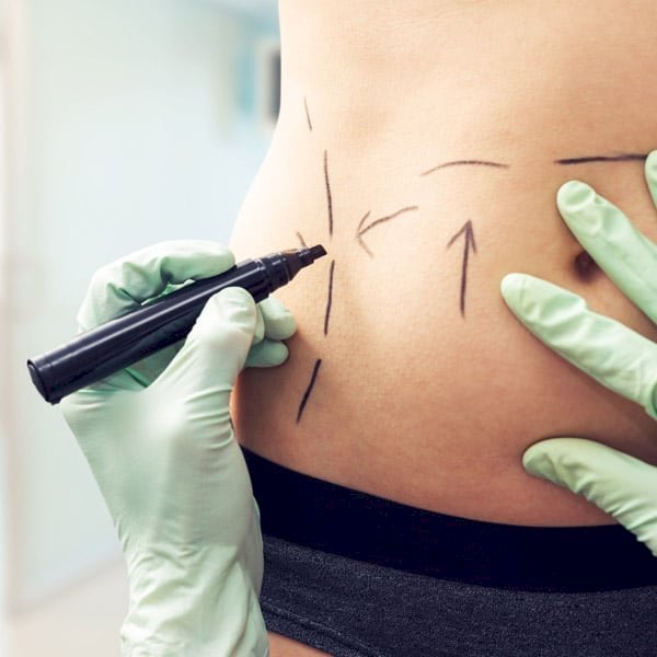Factors That Affect Liposuction Cost in Dubai