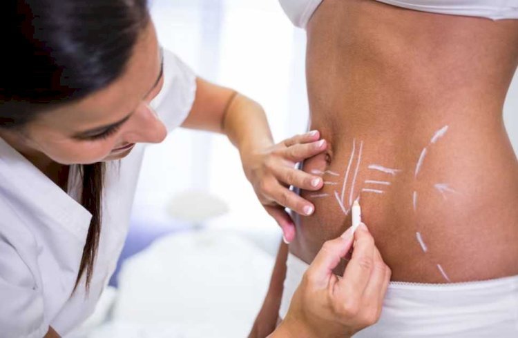 Free vs. Paid Liposuction Consultations in Islamabad