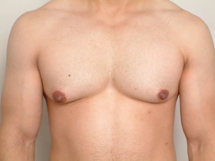 Does Weight Loss Eliminate Gynecomastia Completely?