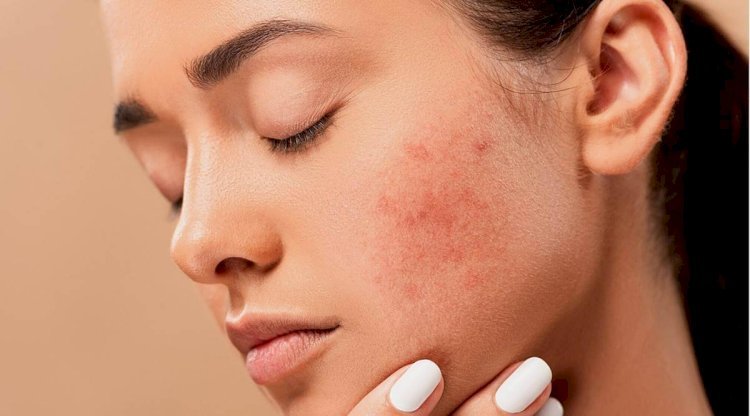 What is the Most Effective Treatment for Acne?