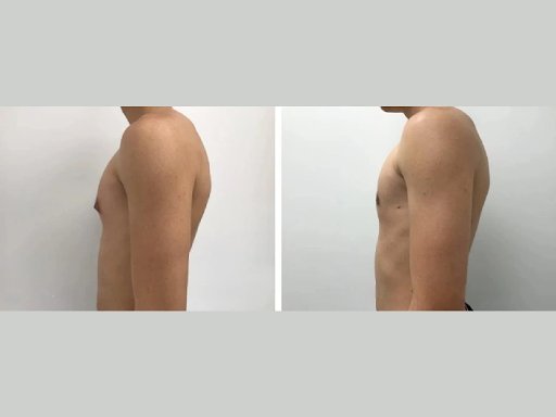 Male Boob Surgery in Dubai: Understanding the Benefits of Gynecomastia Surgery