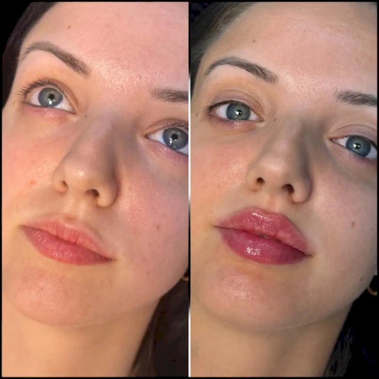 How the Best Plastic Surgeons in Dubai Customize Fillers for Different Facial Structures