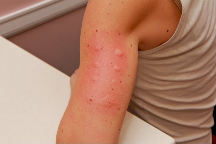 The Hidden Link Between Allergies and Fatigue: When to Consider Allergy Testing in Dallas