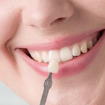 Is There Pain During or After Composite Veneers?