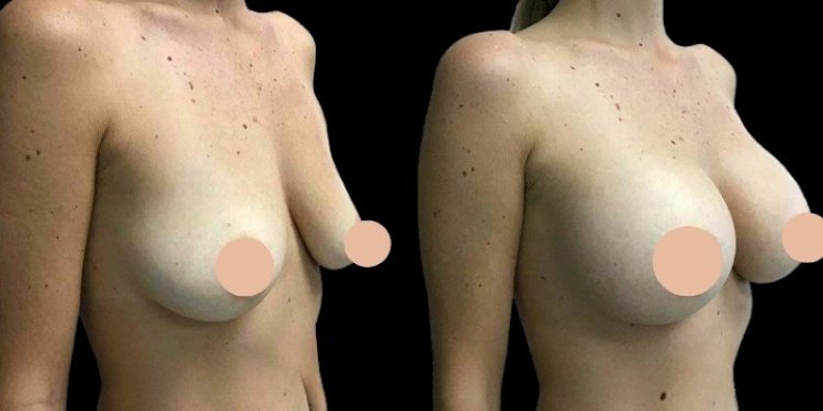 Why Safety Comes First with the Best Doctors in Dubai for Breast Augmentation Surgery