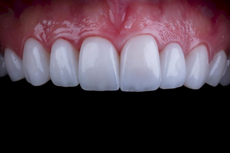 Composite Veneers and Diet: How Food Impacts Longevity