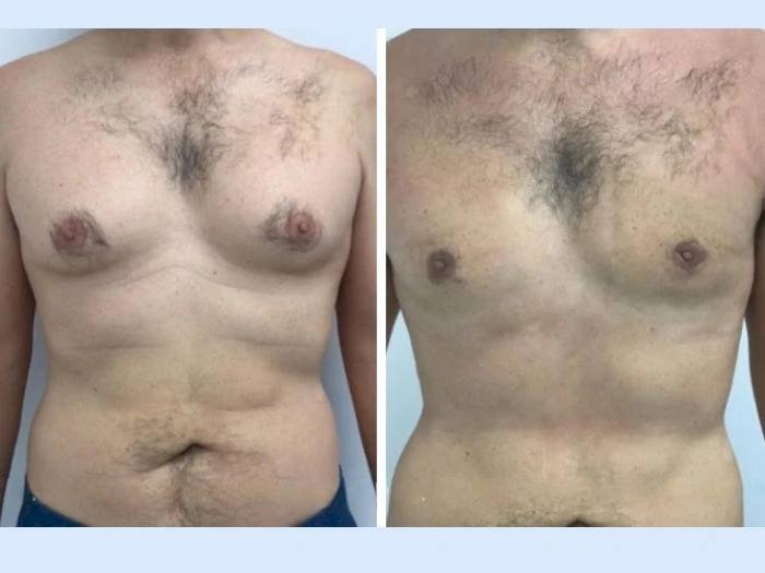 Gynecomastia in Dubai: Top Surgical Options for Male Chest Contouring