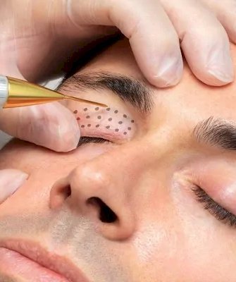 What Areas Can Be Treated with Plasma Pen?
