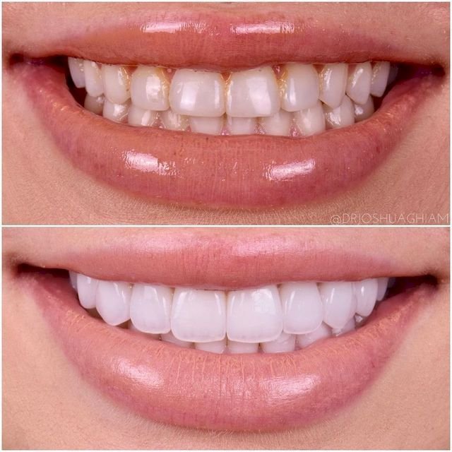 Dental Implants in Sacramento: A Complete Guide to Restoring Your Smile