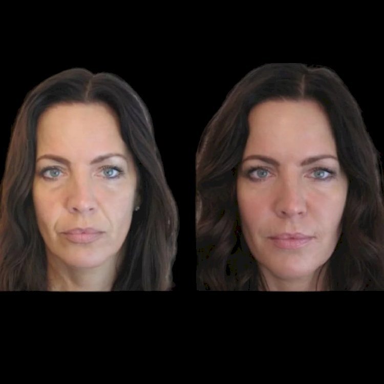 The Best Aesthetic Clinics in Dubai for Perfect Jawline Sculpting