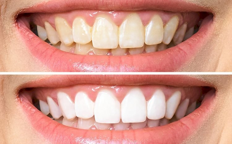 Teeth Whitening Cost or At-Home Kits: Which Lasts Longer?